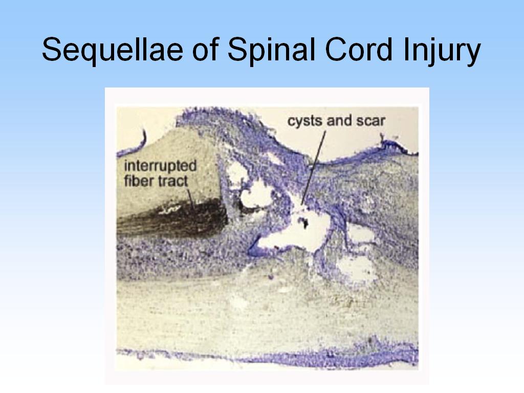 Sequellae of Spinal Cord Injury